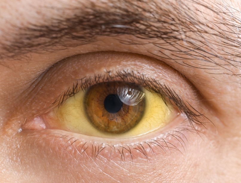 miért sárga szem fehérje oka