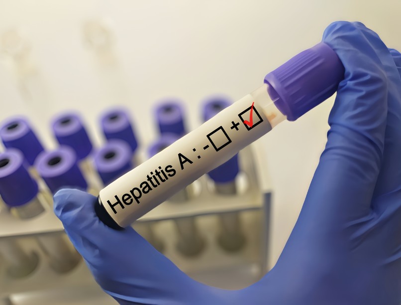 Hepatitisz A