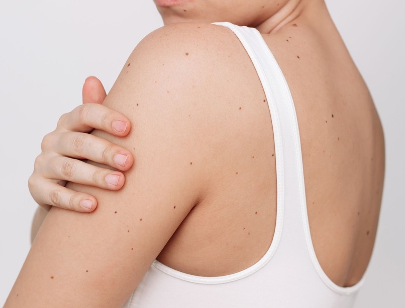 bőrrák melanóma daganat rák