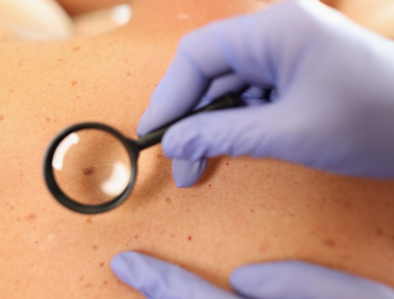 anyajegy, eltávolítás, bőrgyógyász, sebész