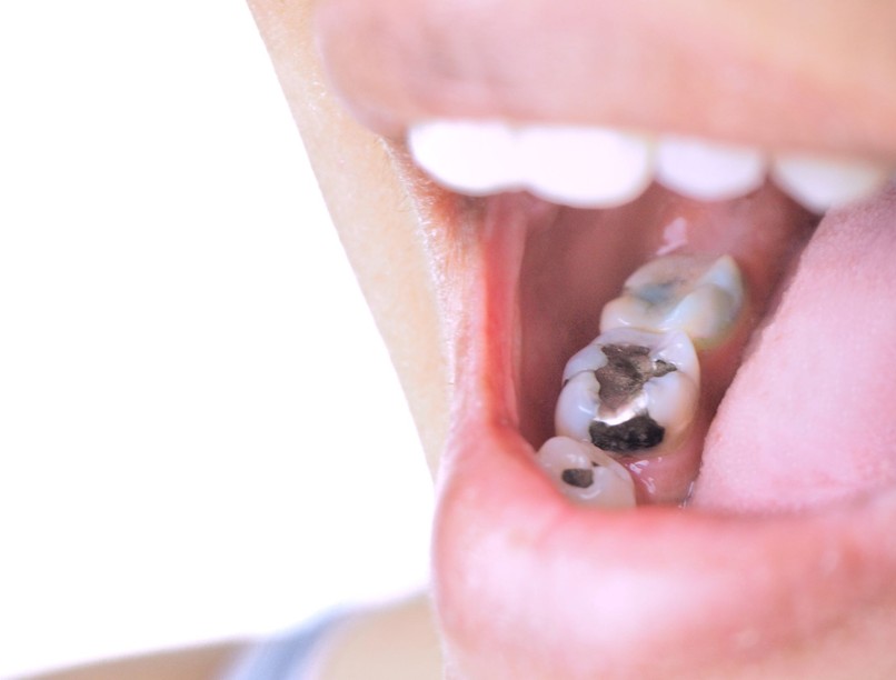 orvos válaszol amalgám tömés higany veszélyes