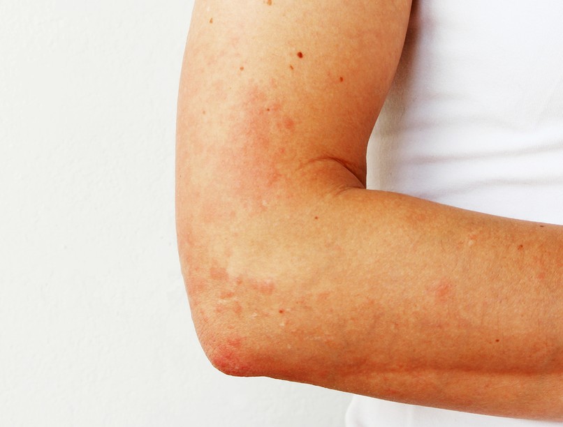 napallergia, melegkiütés, kiütés, bőr, ödéma, viszketés