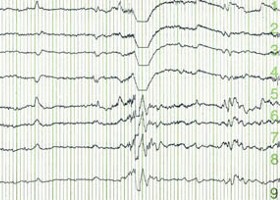 Az elektroenkefalogram (EEG)