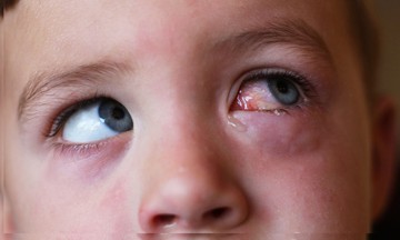 Van olyan szemcsepp, amit vény nélkül lehet kapni kötőhártya-gyulladásra? Az orvos válaszol