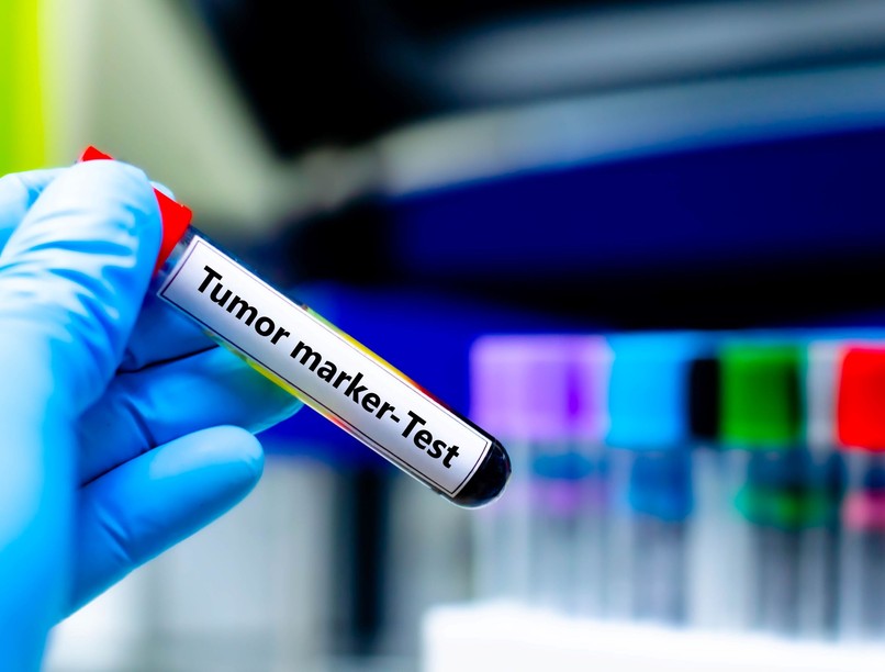 tumormarker vizsgálat PSA CA-125 CEA jelentés