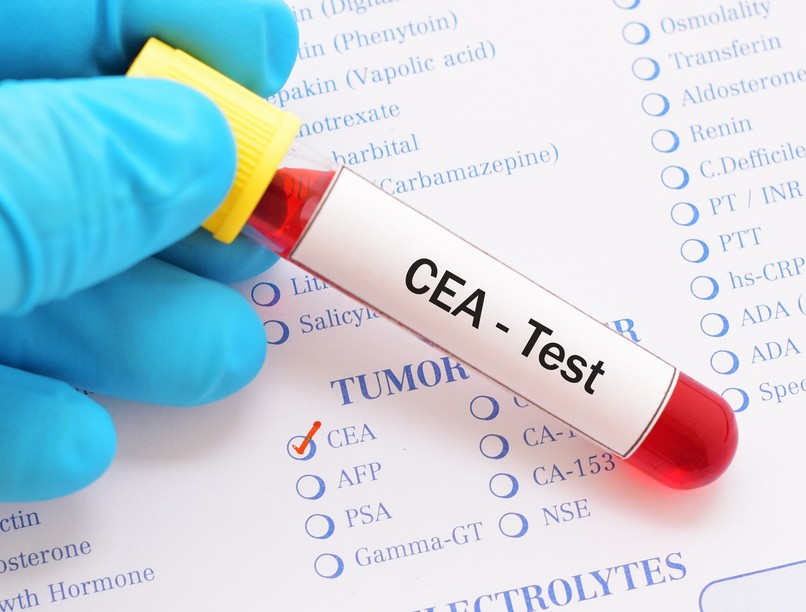 Mit jelent CEA karcinoembrionális antigén érték laborlelet