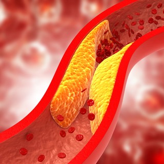 Magas a koleszterinje? Így csökkentheti legjobban! című cikk nyitóképe