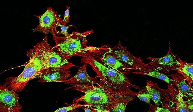 Áttétes rák: ezeken múlik, hogy szétterjed-e a daganat