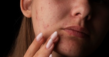  Felnőttkori pattanások: miért nem csak kamaszprobléma? 