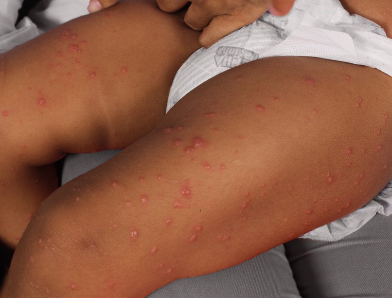 Gianotti-Crosti szindróma, GCS, oka, tünetei, kezelése, fertőző betegség, kiütés, nyirokcsomó, bőrbetegség