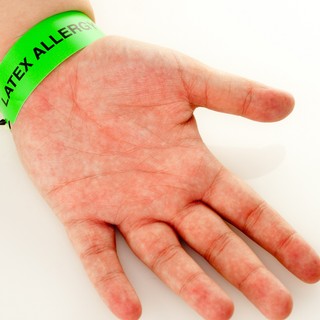 Latex allergia: tünetek, megelőzés és biztonságos alternatívák című cikk nyitóképe