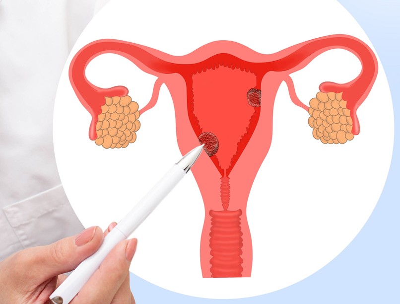 méhnyálkahártya daganat korai rák tünet jel panasz