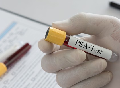 PSA-vizsgálatra készül? A vizsgálat előtti napok eseményei is befolyásolhatják az eredményt című cikk nyitóképe