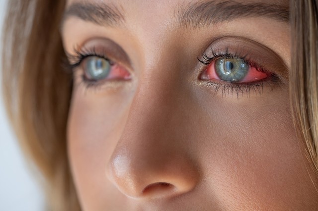 Mi jó szemvörösség ellen? Ezeket lehet tenni a panasz esetén