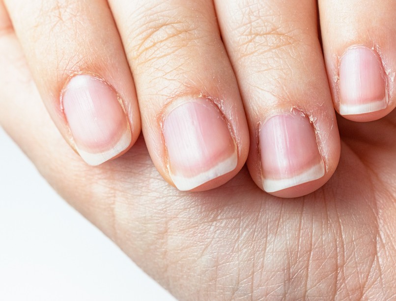 körömágy berepedezés kezelése