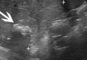 A Wilms tumor a leggyakoribb gyermekkori hasi daganat. A daganat kiterjedésének megítélése céljából olcsó és gyors vizsgálat a hasi ultrahang. Pontos felmérésre a hasi, kismedencei CT illetve MR vizsgálat alkalmas. Szövettani mintavételre csak abban az esetben van szükség, ha az előzetes vizsgálatok alapján a daganat kiterjedése miatt műtétileg eltávolítása nem lehetséges.