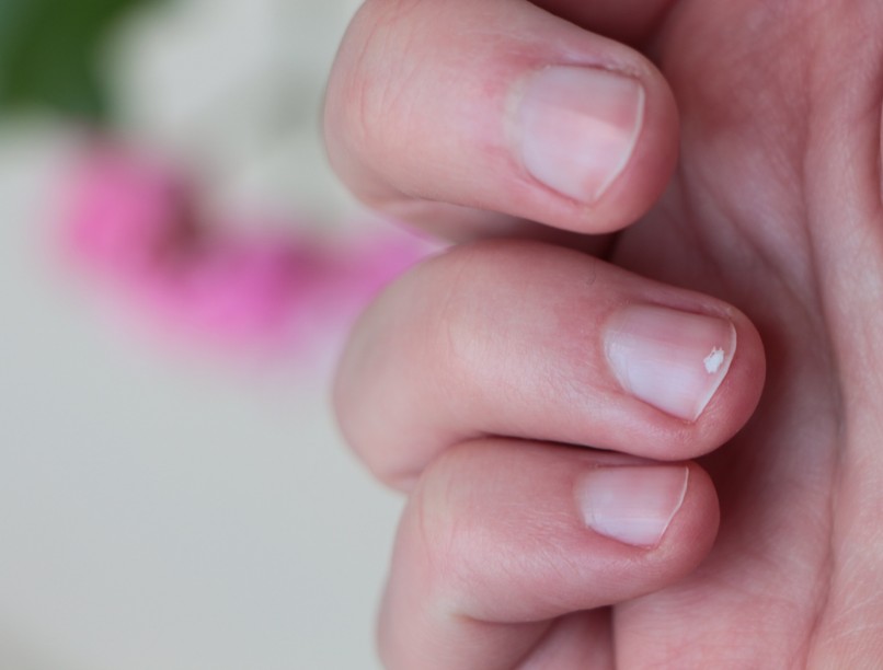 Fehérjehiány mi a jele honnan tudható