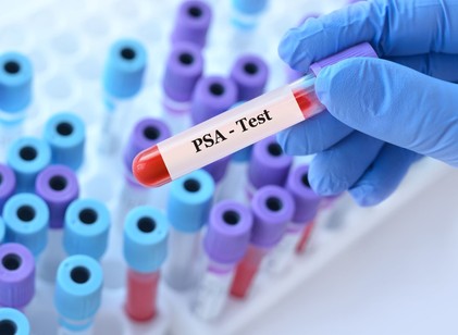 Normális PSA mellett is lehet prosztatarák? A gyakori teszt nagy félreértései című cikk nyitóképe
