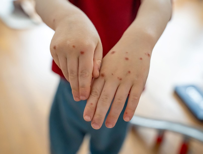 Coxsackie-vírus Ukrajna járvány