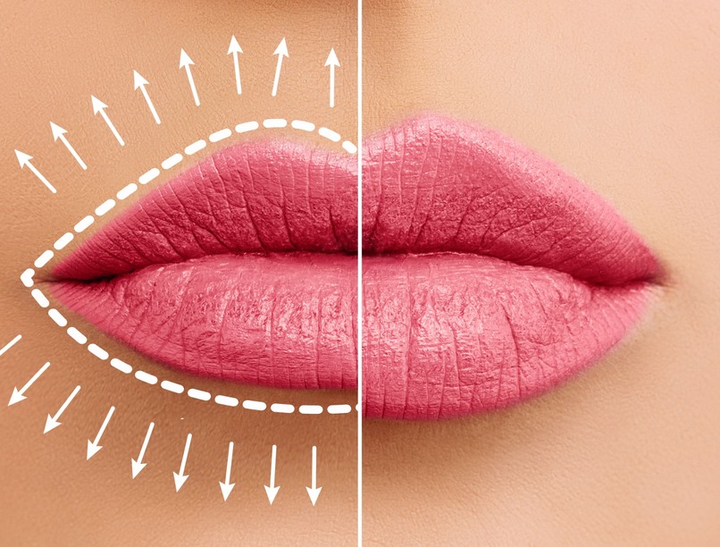 ajakfeltöltés, ajaknagyobbítás, hialuronsav