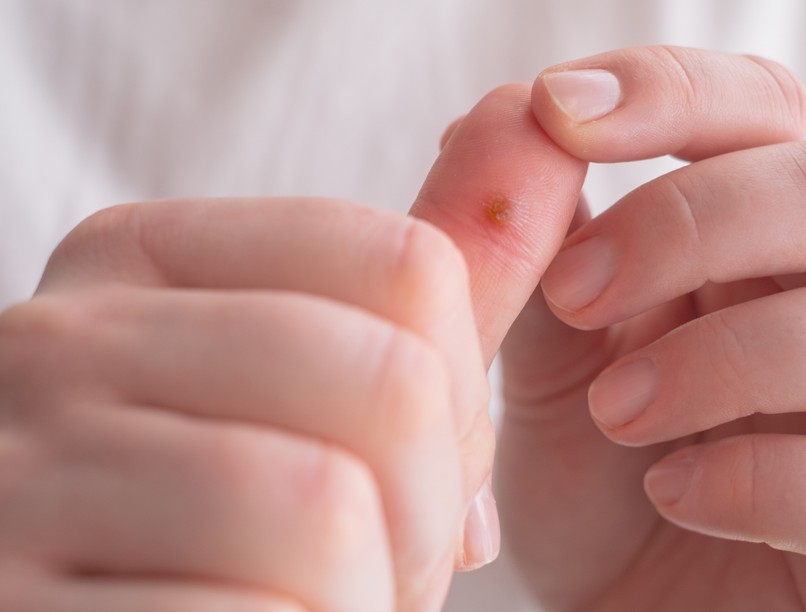 Szemölcs tünet vizsgálat kezelés