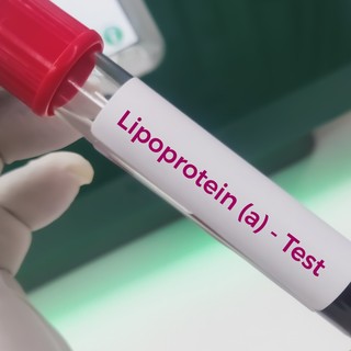 Magas lipoprotein(a)-szint: ezért fontos tudni az örökletes lipidzavarról című cikk nyitóképe