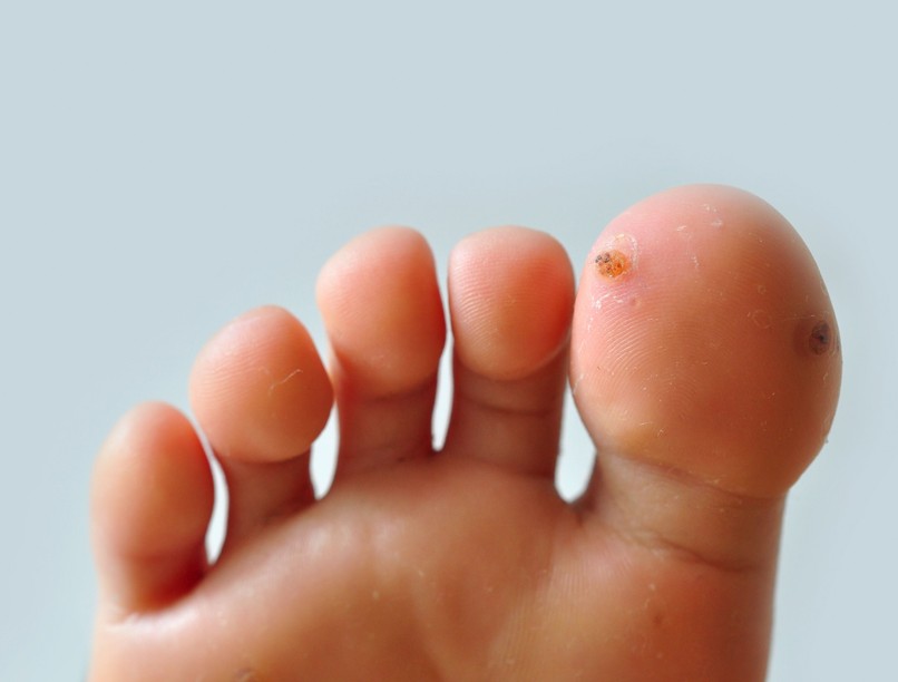 szemölcs talpon gyerek fájdalom HPV vírus