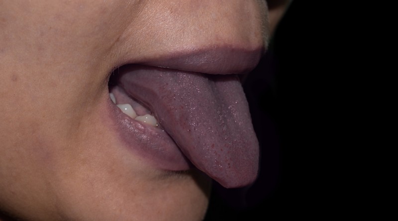 Mire utal a szederjesség (kékes bőrszín)?