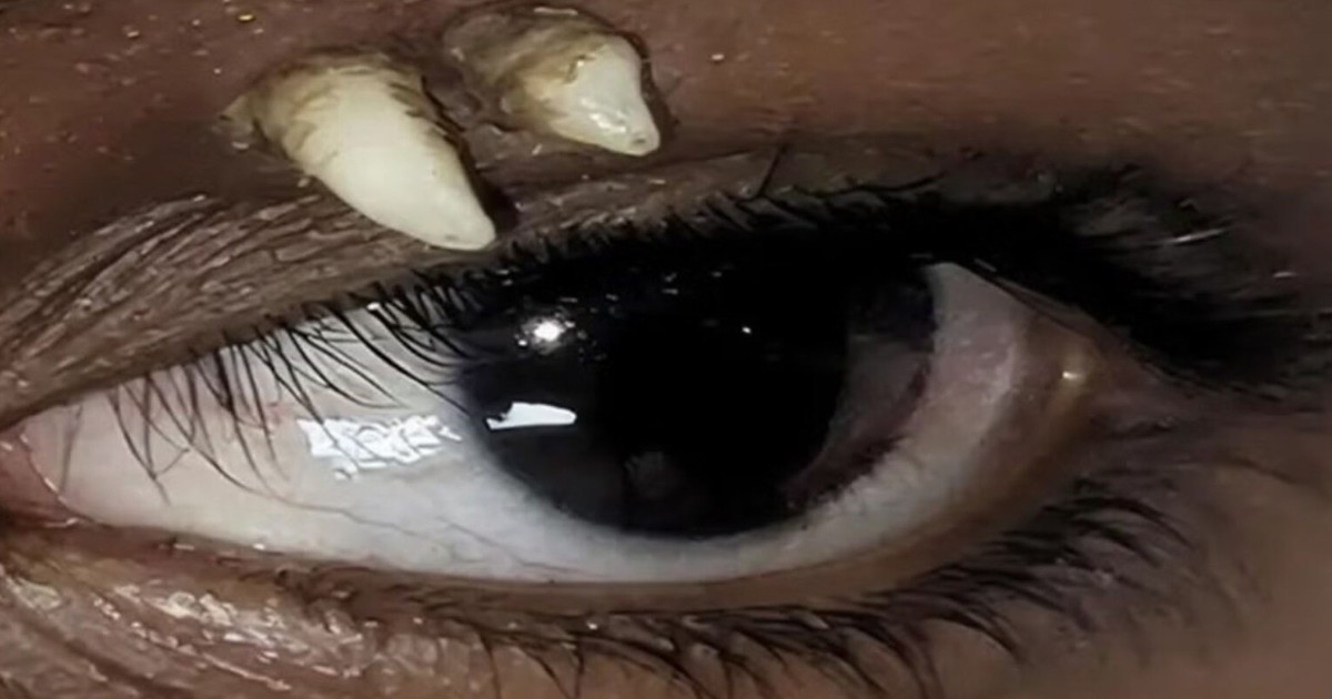 Rare Case: Fully Developed Tooth Found in 16-Year-Old Boy's Eye Socket