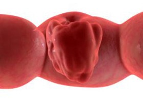 Rákkutatás: egyetlen génnel a vastagbélrák ellen