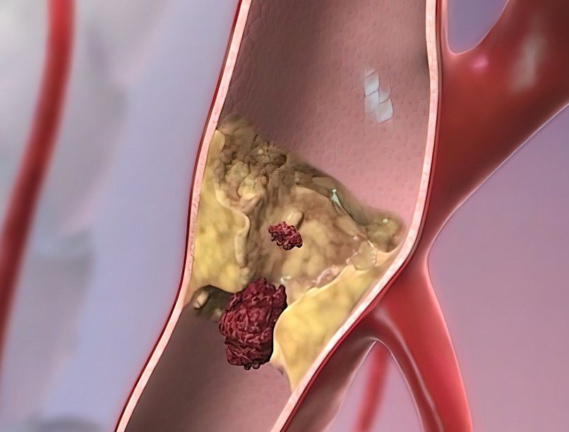 agyi katasztrófa népbetegség enyhe súlyo sztrók stroke