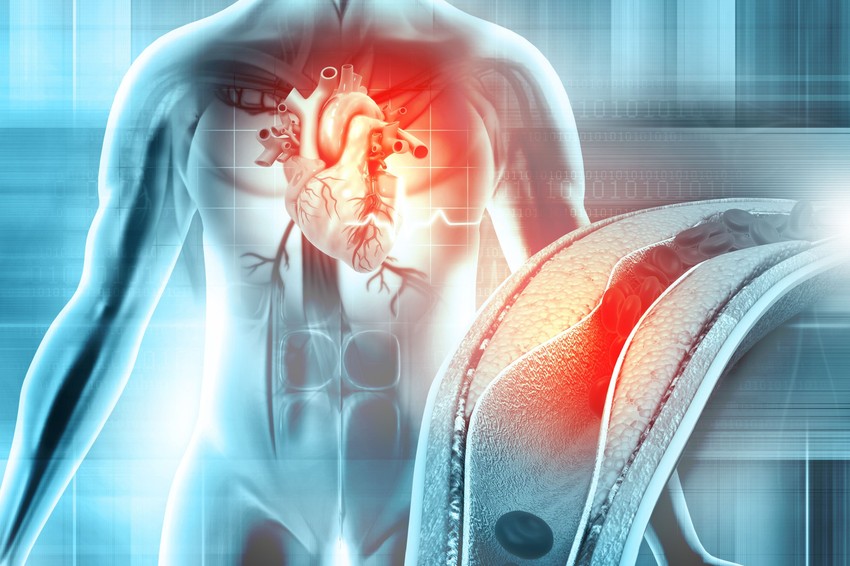 Az infarktus jellemző tünetekkel jár, viszont más betegség is képes infarktust "utánozni".