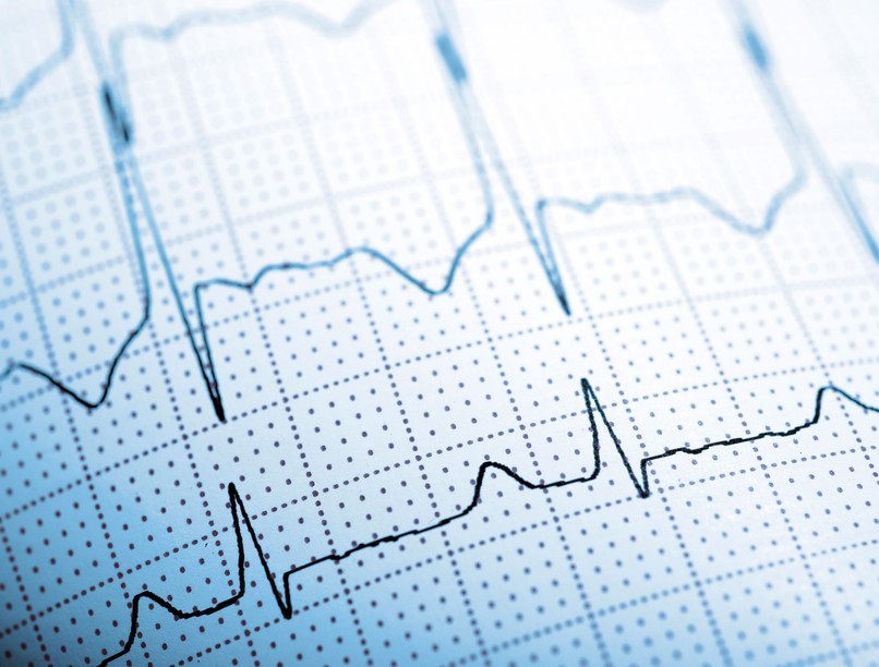 uj-ai-eszkoz-felismeri-a-szivbetegsegeket-az-ekg-bol