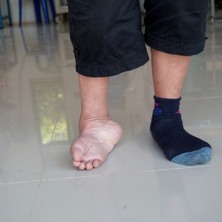 Dongaláb tünetei, vizsgálata és kezelése című cikk nyitóképe