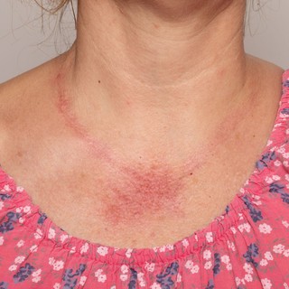 Kiütés, bőrpír a nyakon, dekoltázson, köldökön, csuklón: ettől alakulhat című cikk nyitóképe