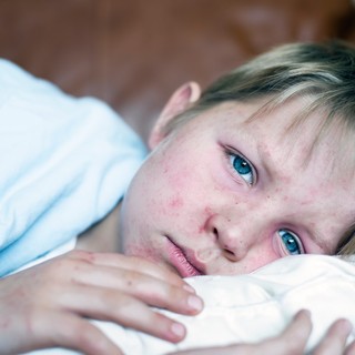 Óriási erővel rúgta be az ajtót a kanyaró – aggódnak a szakemberek című cikk nyitóképe