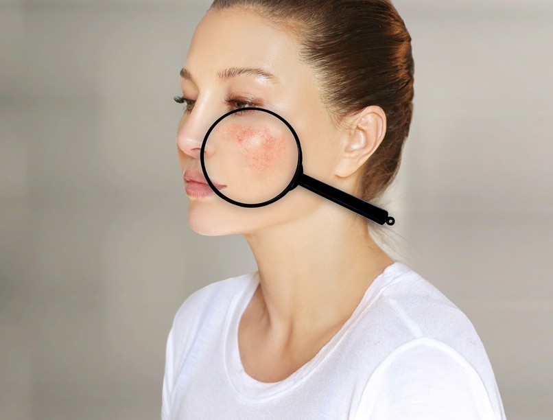 gyulladás bőrpír jele arcon autoimmun betegség lupusz tünete