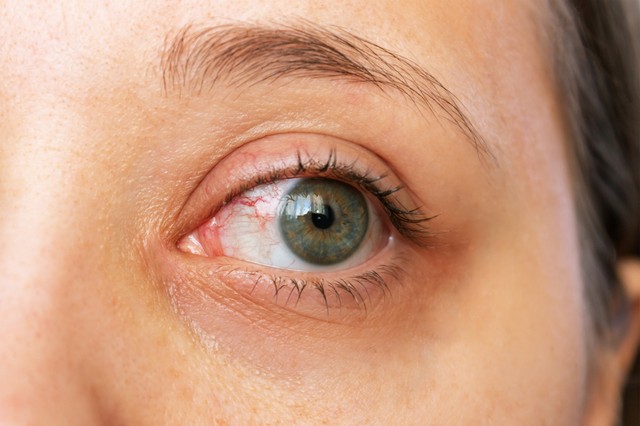 Kötőhártya-gyulladás: ezt teheti otthon, hogy gyorsabban gyógyuljon