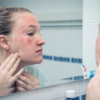 Mire utal a kivörösödött bőr? című cikk nyitóképe