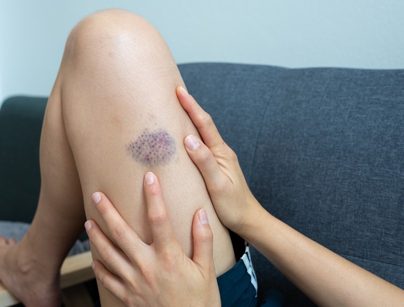 leukémia tünet véraláfutás, kiütés ízületi fájdalom