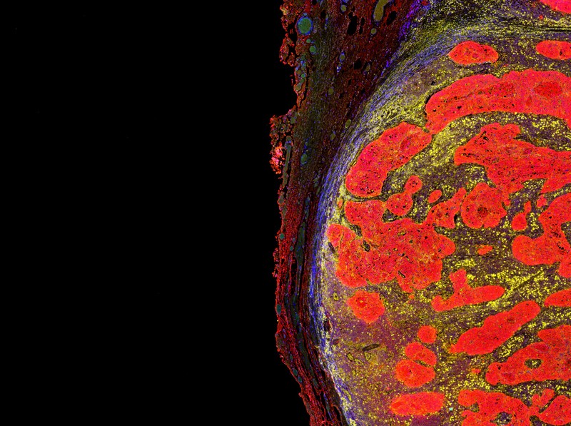 Hideg és forró tumorok: ettől függhet az immunterápiás rákkezelés hatásossága!