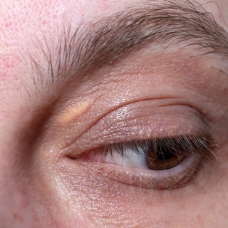 Ha ehhez hasonló sárga kitüremkedést lát a szemhéján, nagyobb az esélye az infarktusra című cikk nyitóképe