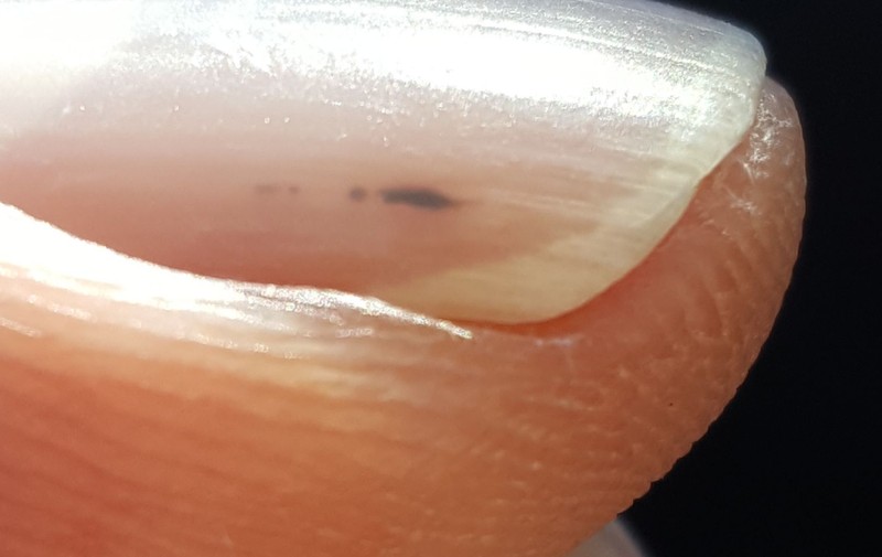 Szálkavérzések: ezt jelenti, ha fekete vonalak jelennek meg a körmökön