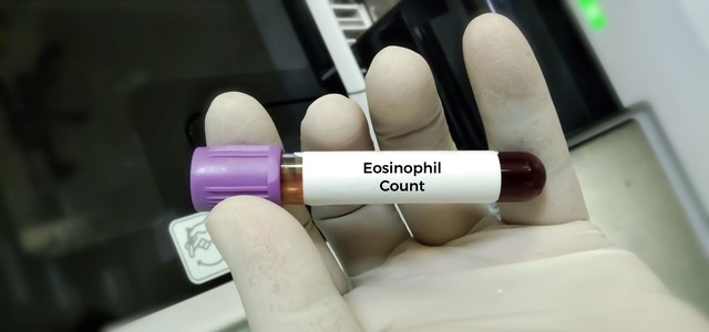 Mitől lehet magas a eosinophil a vérképben? Ezeket mindenképp tudnia kell!