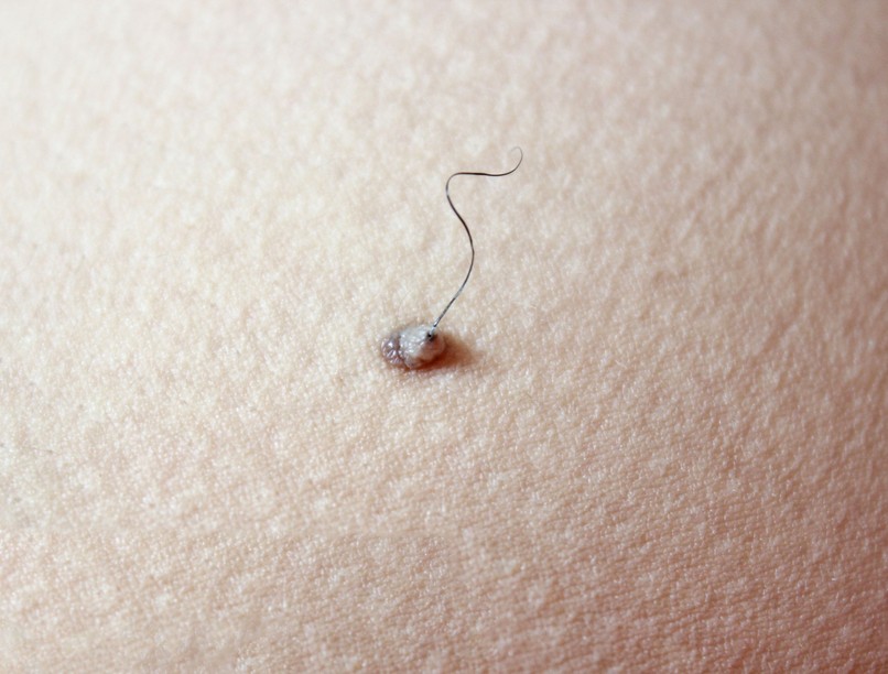szőrszál kihúzása anyajegyből rák melanóma