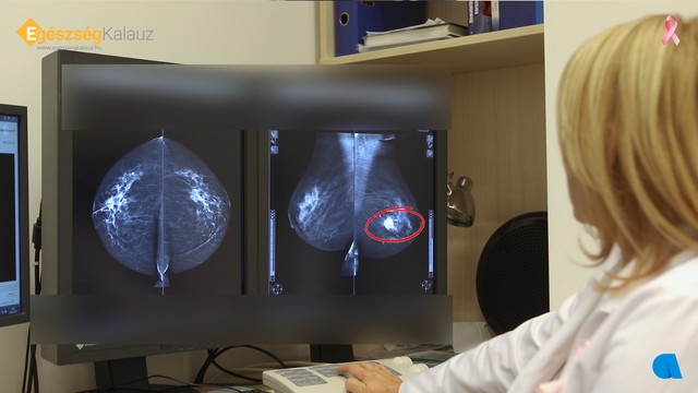 Nem fáj, 3 perc: hogyan zajlik a mammográfiás vizsgálat?