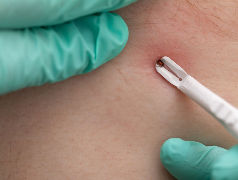 kullancs eltávolítása, Lyme-kór, fertőzés élősködők