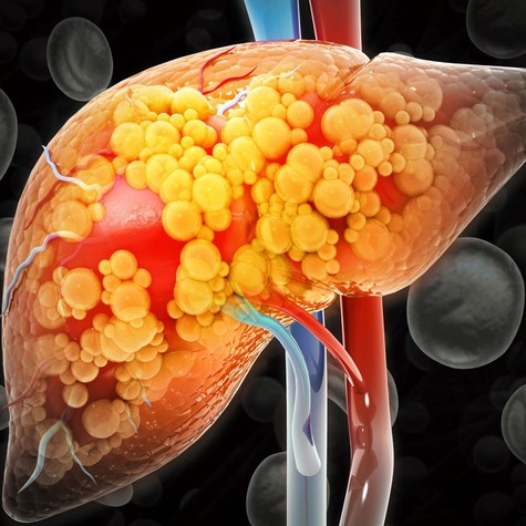 Csendben károsít, mégis sokakat érint: honnan tudhatja, hogy Önnél is jelen van a zsírmáj? című cikk nyitóképe