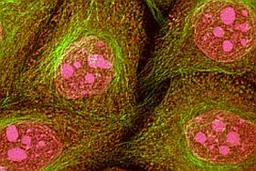 Hőtérképes vérvizsgálattal kimutatható a méhnyakrák?