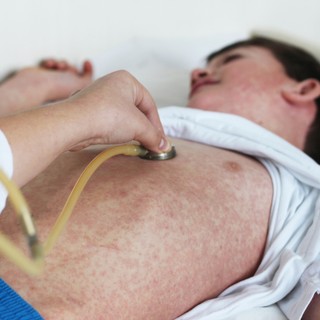 Aggasztó méreteket öltött a kanyaró terjedése a világban című cikk nyitóképe